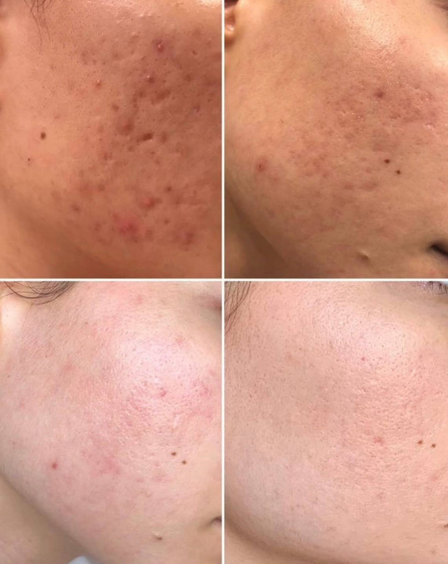 ژل ضد جای زخم و التهاب